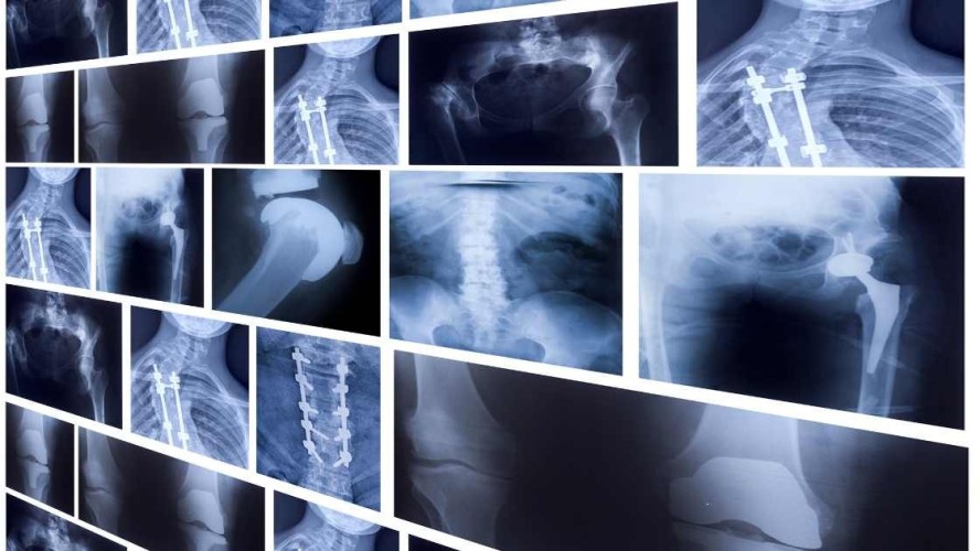 Do I need an XRay or MRI before My Chiroapractic Appointment